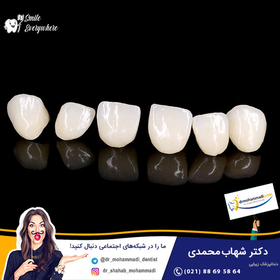 مهمترین تفاوت های لومینیرز و لمینت - کلینیک دندانپزشکی دکتر شهاب محمدی